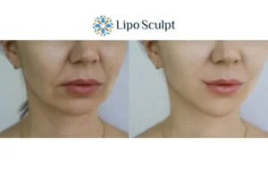 Explaining Total Skin Tightening Treatment And What It Can Do For You 2 Do you want to boost your self confidence? Give Morpheus8 Solihull a try today!
