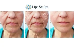 Explaining Total Skin Tightening Treatment And What It Can Do For You 3 Boost your confidence with Morpheus8 Solihull call our team today!