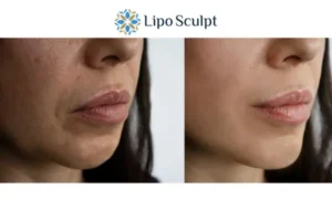 Explaining Total Skin Tightening Treatment And What It Can Do For You 4 Morpheus8 Solihull the best results - call our team today!