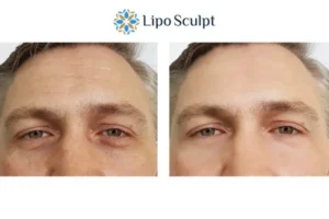 Explaining Total Skin Tightening Treatment And What It Can Do For You 6 Morpheus8 Solihull book in today to find out more!